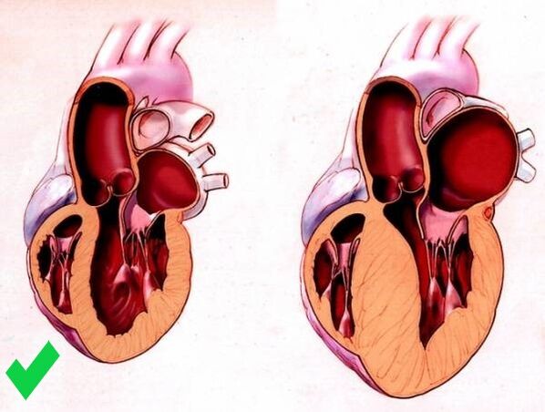 Cardione bihotzaren hipertrofia bentrikularra saihesten du